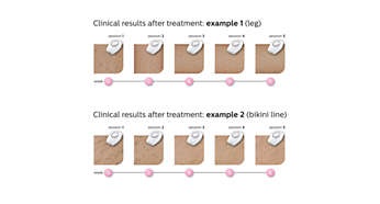 Philips Lumea Comfort Ipl Hair Removal System Sc1981 100 000