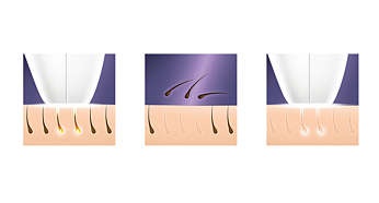 Philips Lumea Comfort Ipl Hair Removal System Sc1981 100 000