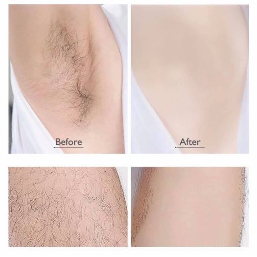 Chai Xịt Tẩy Lông DETVFO 150ml Mới Dùng Siêu Thích | Kem Tẩy Lông DETVFO Dạng Xịt Dịu Nhẹ Không Đau