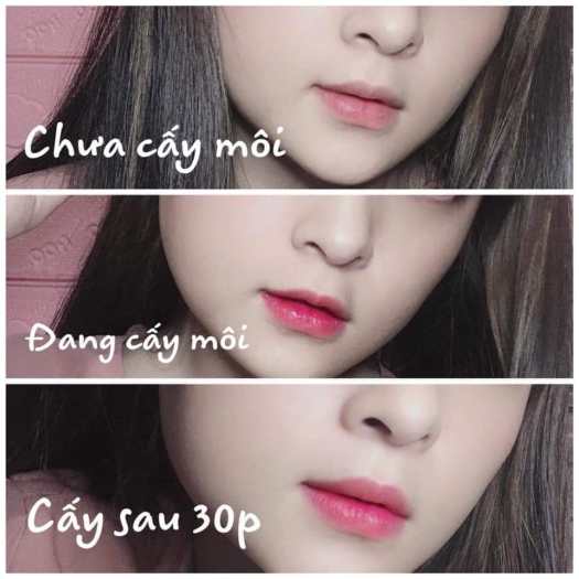 Cấy môi VAURA 2 làm hồng môi, trị thâm môi BABIER LIPS VOLUME