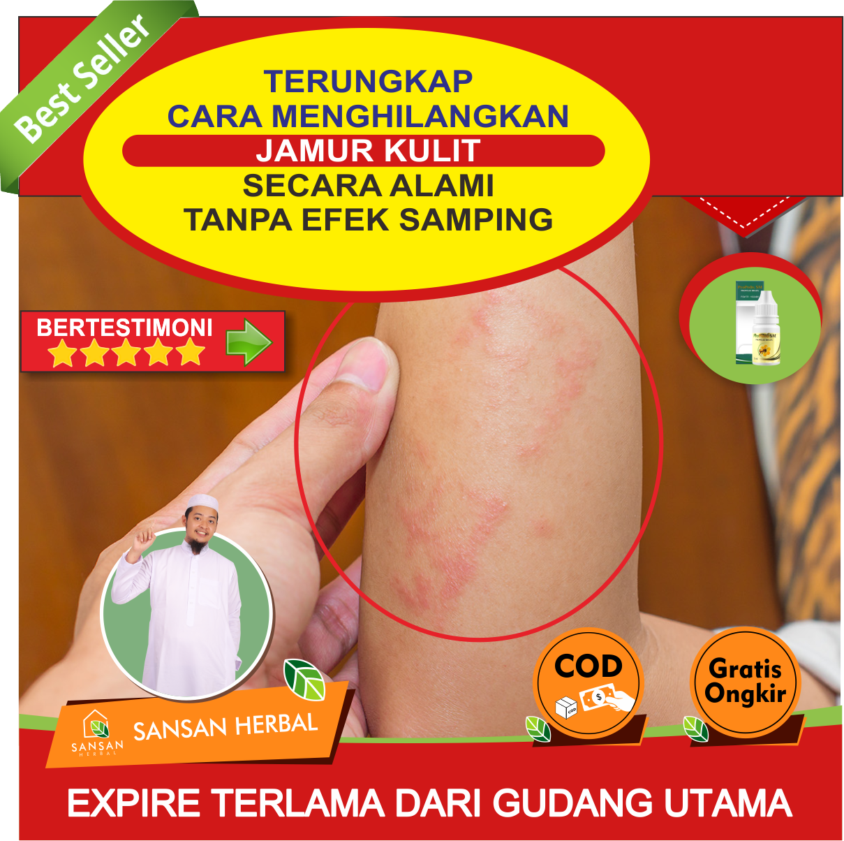 Cara menghilangkan gatal didaerah selangkangan