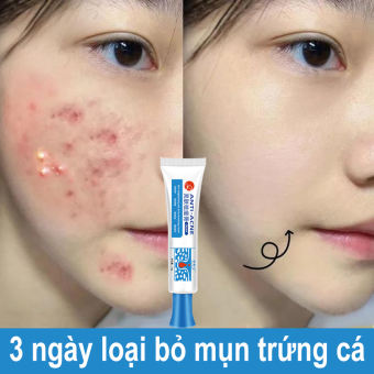 Kem loại bỏ mụn nhanh chóng loại bỏ mụn bọc,kem chấm mụn tận gốc,chóng loại bỏ mụn bọc,giảm thâm ngăn mụn tái phát, kem bôi mụn làm mờ thâm 25g