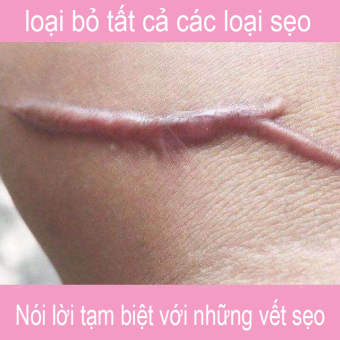 Kem xóa sẹo 20g, giảm sẹo, vết bỏng, vết bỏng, vết cắn, vết mổ, vết mổ lấy thai, vết mụn trên mặt và toàn thân, vết rạn da, thúc đẩy tái tạo da, làm mịn da