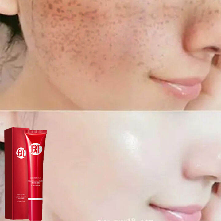 (7 ngày loại bỏ tàn nhang) Kem loại bỏ tàn nhang sáng da loại bỏ nám loại bỏ hắc tố và làm dịu giảm mẩn đỏ và sưng tấy Kem làm trắng da