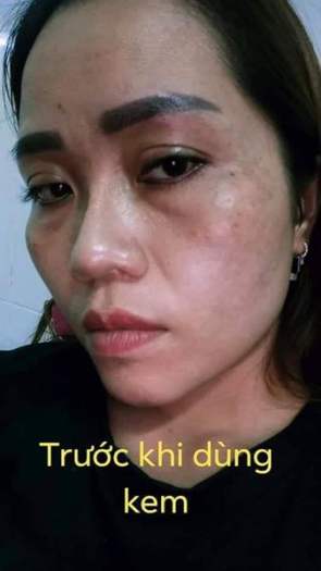 Kem nám tàn nhang đồi mồi EVER TODAY (6g)