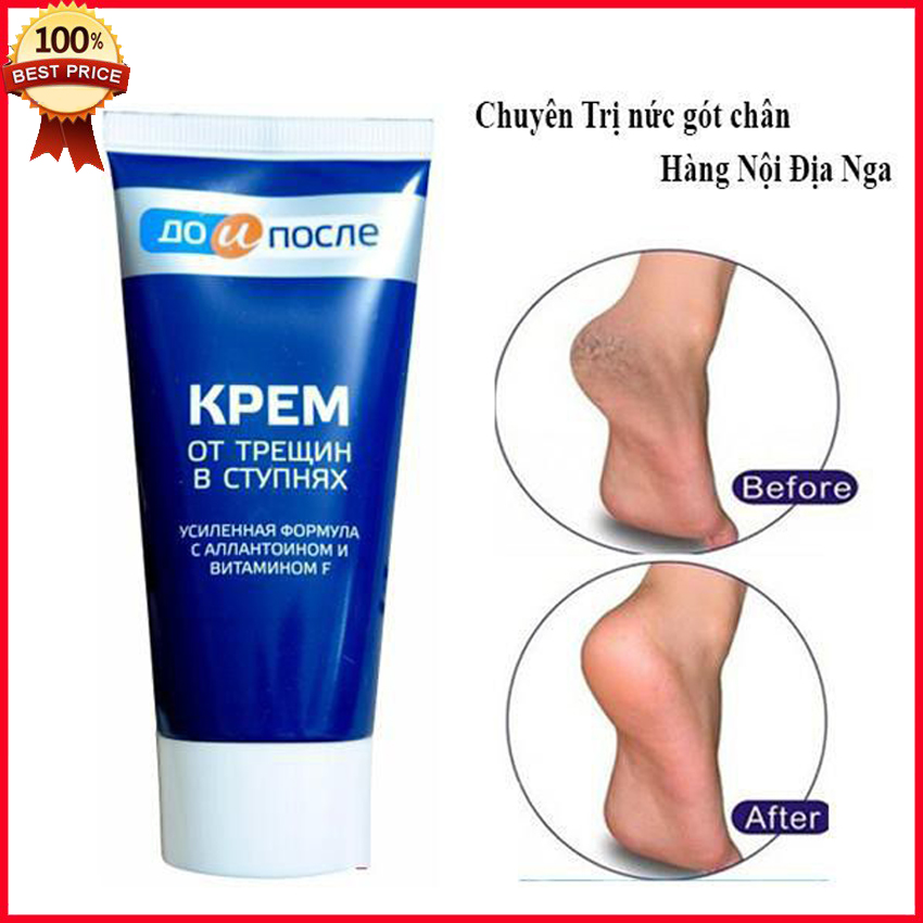 Kem ngăn ngừa và hồi phục nứt nẻ gót chân chính hãng kpem nga 50ml - giữ ẩm, làm mềm da chân, giảm nứt nẻ gót chân, mau kéo da non, giúp tái tạo da gót chân - trâu beauty