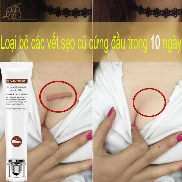 Kem Xóa Sẹo kem xóa sẹo lâu năm Làm Mờ Sẹo Sửa Chữa Vết Rạn Da Khi Mang Thai Xóa Vết Bỏng，Kem che sẹo，các loại sẹo khác nhau làm mờ sẹo kem trị sẹo Xóa sẹo nhanh chóng mờ sẹo thâm mụn,mờ thâm ,khổi phục da