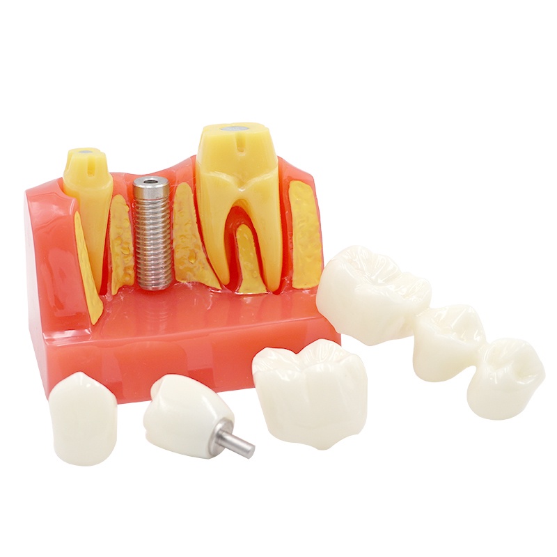 Gambar 4X  Implant Teeth  model dental model dental teaching model