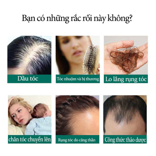 Tóc rụng nhiều ở nam giới là do đâu  VITA Clinic
