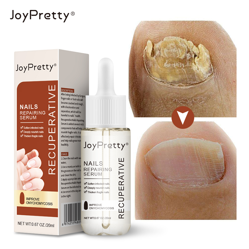 Woolove joypretty huyết thanh điều trị nấm móng chân dầu dưỡng móng chống nấm chăm sóc bàn chân gel loại bỏ thuốc kháng nấm 20ml