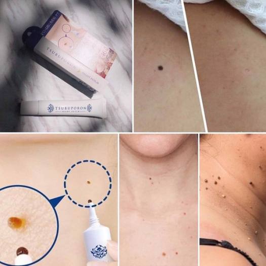 Kem Xoá Mụn Ruồi Tsubuporon Night Patch 20g Nhật Bản