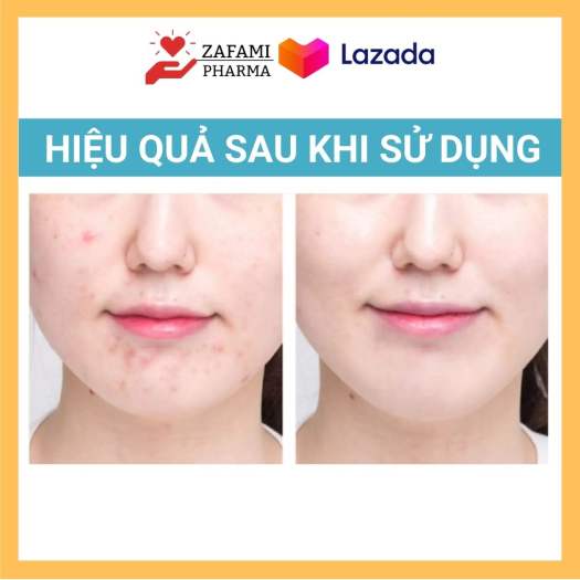 Chấm mụn Fixderma Salyzap kem chấm mụn, tẩy tế bào chết, đánh bay mụn ẩn, mụn đầu đen, giảm thâm da mụn, có thể thay thế chấm mụn neogen, differin, miếng dán mụn (20ml) - Zafami Pharma