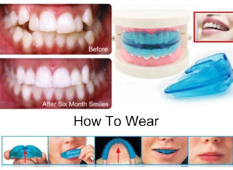 BỘ NIỀNG RĂNG TẠI NHÀ, DỤNG CỤ NIỀNG RĂNG THÔNG MINH THẾ HỆ MỚI CHO MỌI LỨA TUỔI