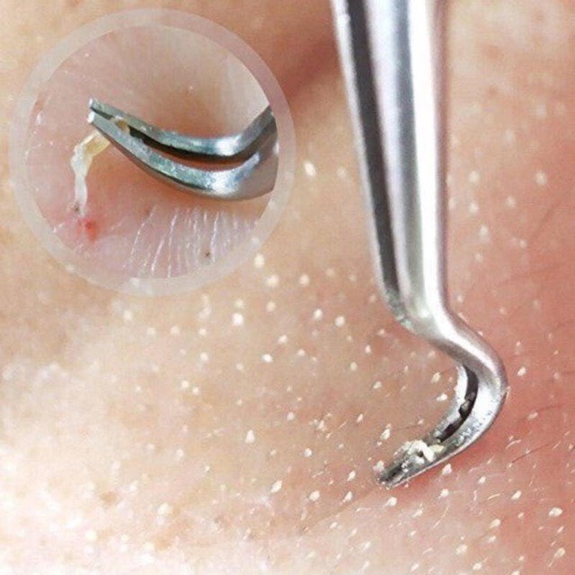 Nhíp gắp mụn thần thánh hàn quốc