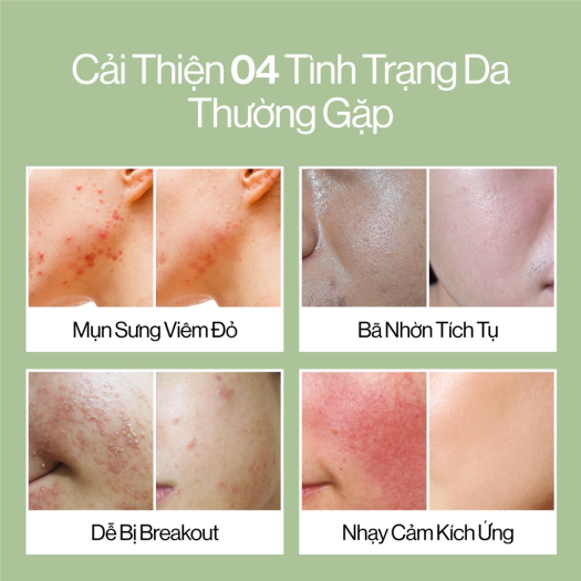 Bộ 4 Sản Phẩm làm sạch, giảm mụn, ngừa thâm & ngăn ngừa mụn tái phát GILAA BITTER MELON BLEMISH REPAIR