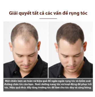 Tinh dầu kích mọc tóc, ngăn ngừa rụng tóc, chai tinh dầu,tinh chất giúp tóc mọc nhanh , chống rụng tóc Tinh chất tăng trưởng tóc ,Hair Grower, Dầu xả tóc ,Tinh chất ngăn ngừa rụng tóc cho nam và nữ ,30ML