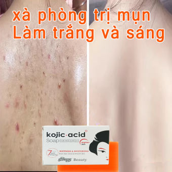 xà phòng kojiesan mụn lưng, trắng da viêm nang lông Loại Bỏ Mụn Lưng Làm sạch sâu bụi bẩn dưới da mụn trứn
