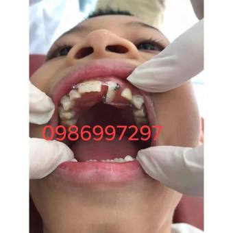 CHỈNH NHA - BUTTON CÁNH TRÒN NÚM - NHA KHOA CHỈNH NHA CHUYÊN NGHIỆP - SANG TRỌNG - ĐẲNG CẤP - DỄ THAO TÁC