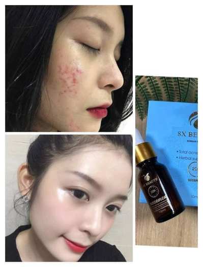 Serum Mụn 20h 8x Beauty Eccence