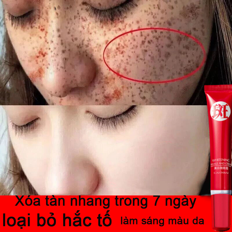 (Loại bỏ tàn nhang trong 7 ngày)Kem làm trắng và loại bỏ nám tàn nhang hiệu quả,Kem làm trắng da và trị tàn nhang hiệu quả, loại bỏ hắc tố, loại bỏ nám, tàn nhang, đồi mồi, làm sáng da và chống lão hóa 20g