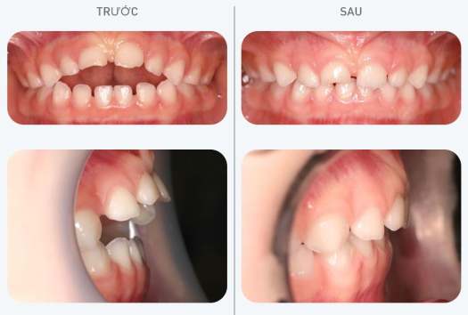 Dụng Cụ Niềng Răng Trainer T4K Hàng ÚC - màu xanh, màu hồng