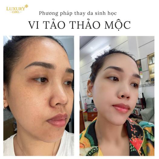Peel Da Vi Tảo Thảo Mộc Luxury Girl Thay Da Sinh Học