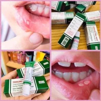Kem Bôi Nhiệt Miệng Trinolone Oral Paste Thái Lan
