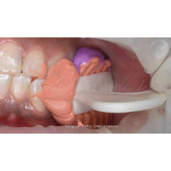 Bộ khay lấy dấu khớp cắn 4 món dùng trong nha khoa