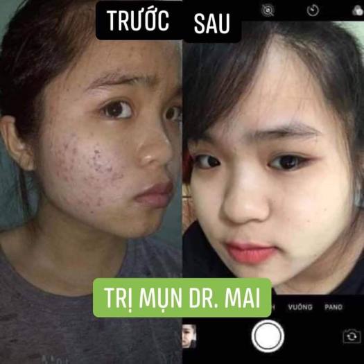 DR MAI TRỊ MỤN - dr mai