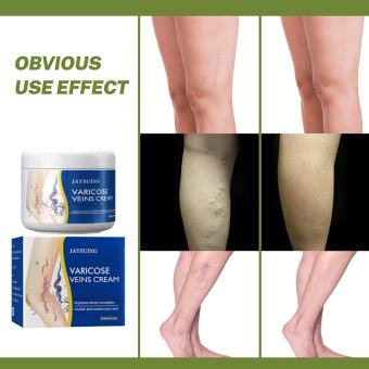 Kem Giảm Suy Giãn hồi chứng suy giãn Tĩnh Mạch phục ngăn ngừa suy giãn tĩnh mạch,thúc đẩy tuần hoàn máu chi dưới