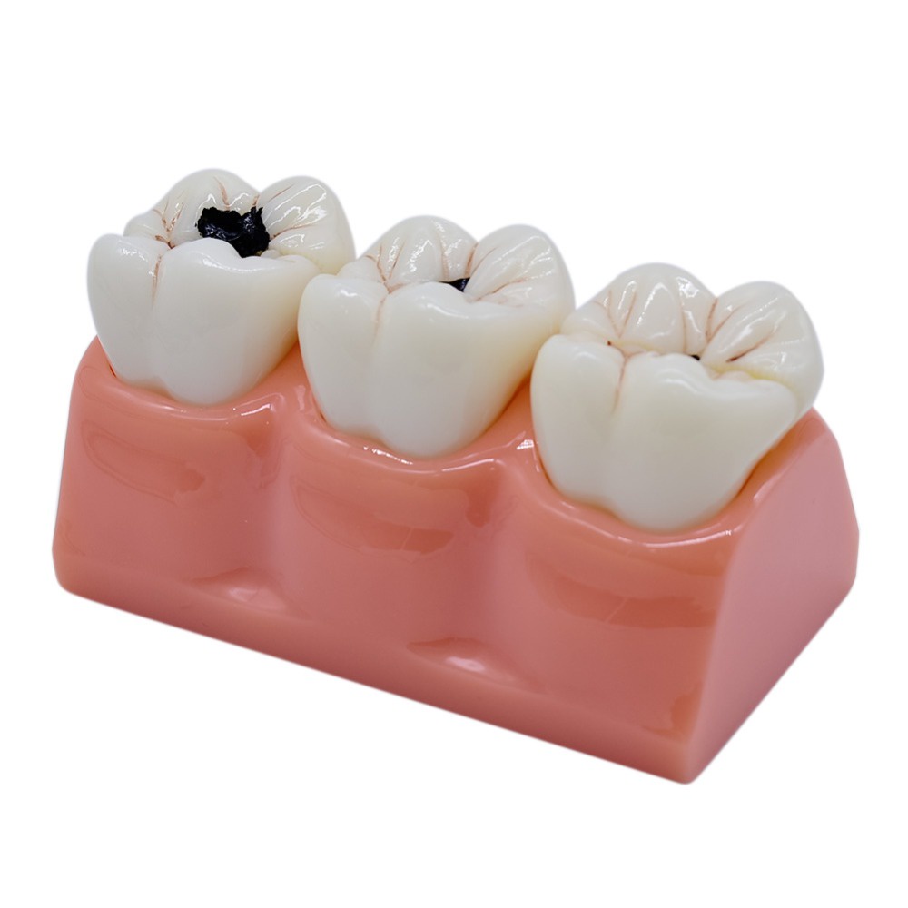 Gambar Dental Model Four Times Caries Evolution Model Tooth Decay Demonstration Caries Process