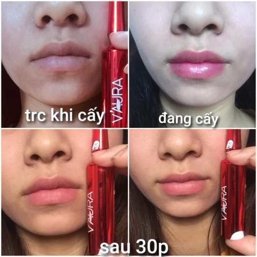 Cấy môi VAURA 2 làm hồng môi, trị thâm môi BABIER LIPS VOLUME