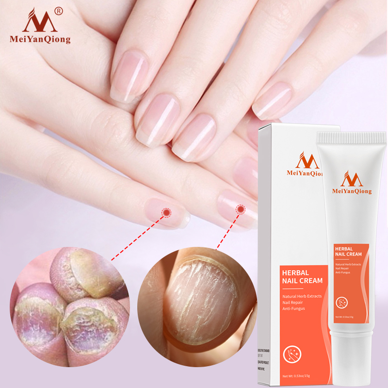 MeiYanQiong Kem dưỡng móng tay chiết xuất thảo dược chống nấm phục hồi móng tay - INTL