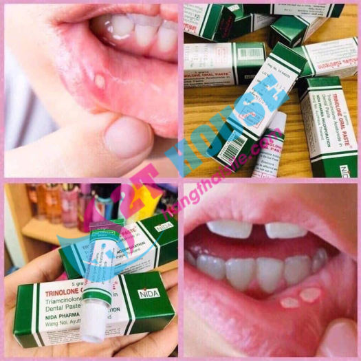 Kem Bôi Nhiệt Miệng Trinolone Oral Paste Thái Lan