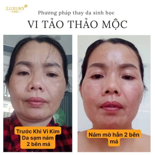Peel Da Vi Tảo Thảo Mộc Luxury Girl Thay Da Sinh Học
