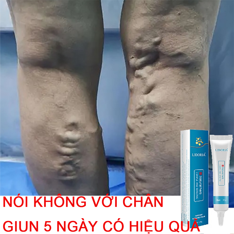 Kem suy giãn tĩnh mạch Kem ngăn ngừa suy giãn tĩnh mạch Thúc đẩy tuần hoàn máu Giảm suy giãn tĩnh mạch, cải thiện tình trạng lồi tĩnh mạch xanh dưới da, thúc đẩy tuần hoàn máu chi dưới, giúp phục hồi và ngăn ngừa bệnh suy giãn tĩnh mạch tái phát