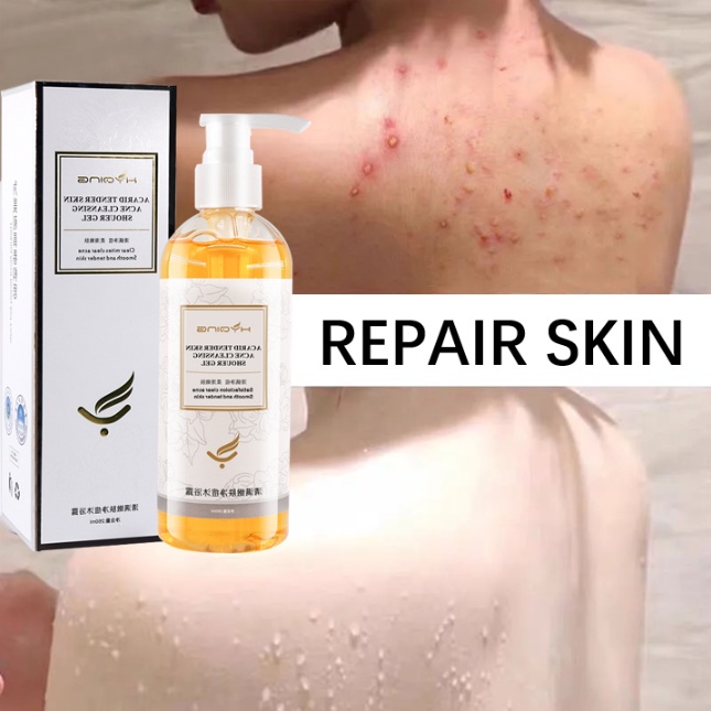 Gambar [Local Stock] Bitter Ginseng Acne Body Wash for Men   Women Anti Mite   Anti Itch 260ml Relieve Dryness   Itchiness Remove Dirt Soft   Moisturizing Anti acne and oil control Back acne female Anti bacterial and anti itch Soothing and Moisturizing