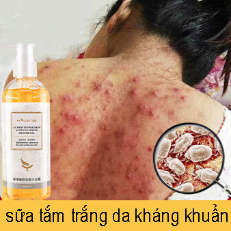 Sữa tắm chống mụn, làm trắng da, chuyên dùng cho da nhạy cảm, sữa tắm hương thơm tự nhiên ngừa mụn, sữa tắm kháng khuẩn cho da khô mụn