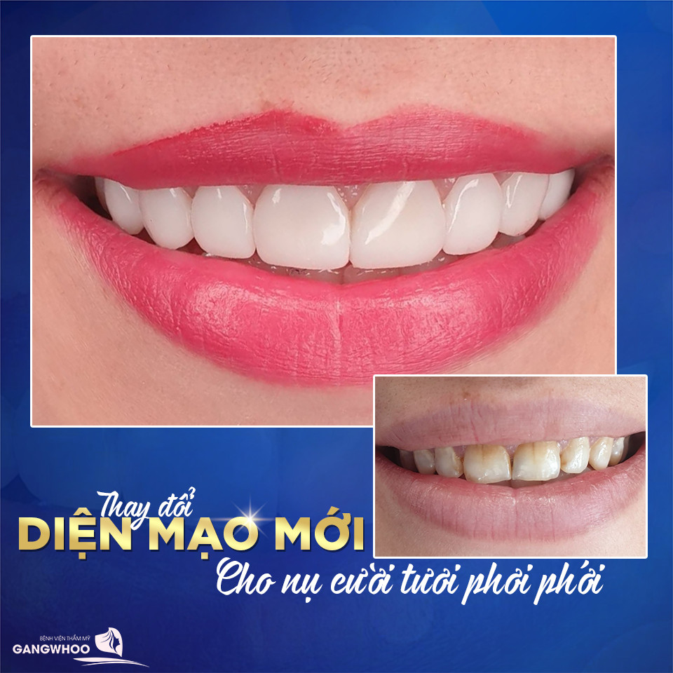 Hệ thống IPM Dentium ( Mỹ ) + Khớp nối