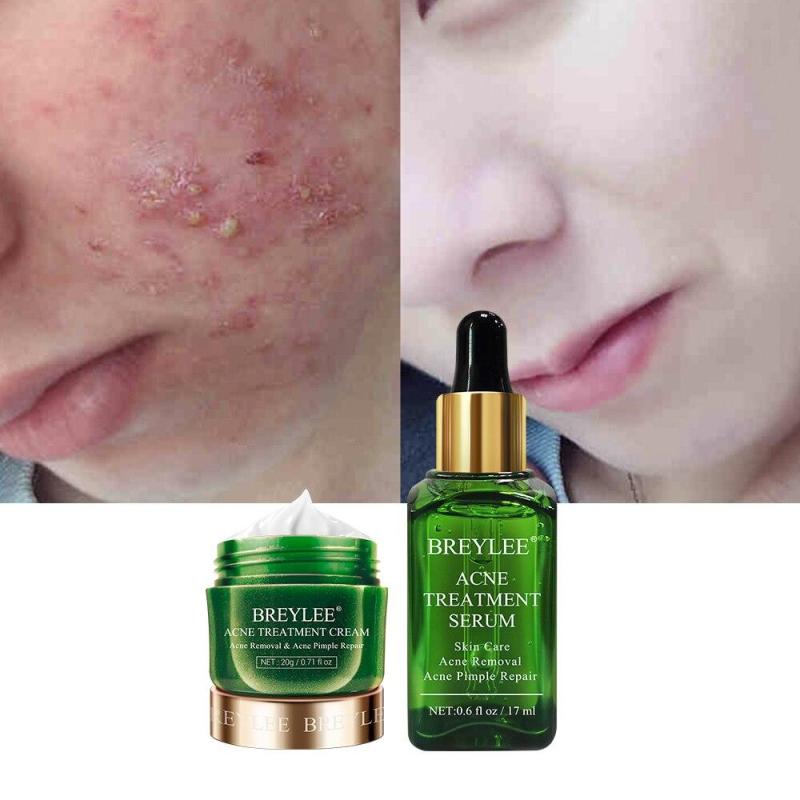 Serum BREYLEE Acne Treatment Kit Mụn Chăm Sóc Da Mặt Kem Dưỡng Da Mặt Skincare Mụn ẩn Chấm Mụn Serum Dưỡng Da Dàm Trắng 17ml