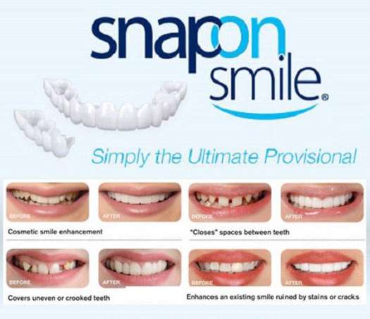 Răng giả Snap on smile