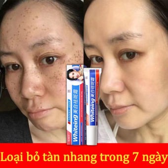 Kem làm trắng và loại bỏ nám tàn nhang Kem nám và chống tàn nhang 20g Kem làm mờ vết thâm làm trắng da Serum xóa vết thâm làm sáng da, Giúp Dưỡng Trắng, Mờ Thâm Nám, Làn Da Đều Màu, giảm đốm tàn nhang, Cam Kết Sạch 95% Nám
