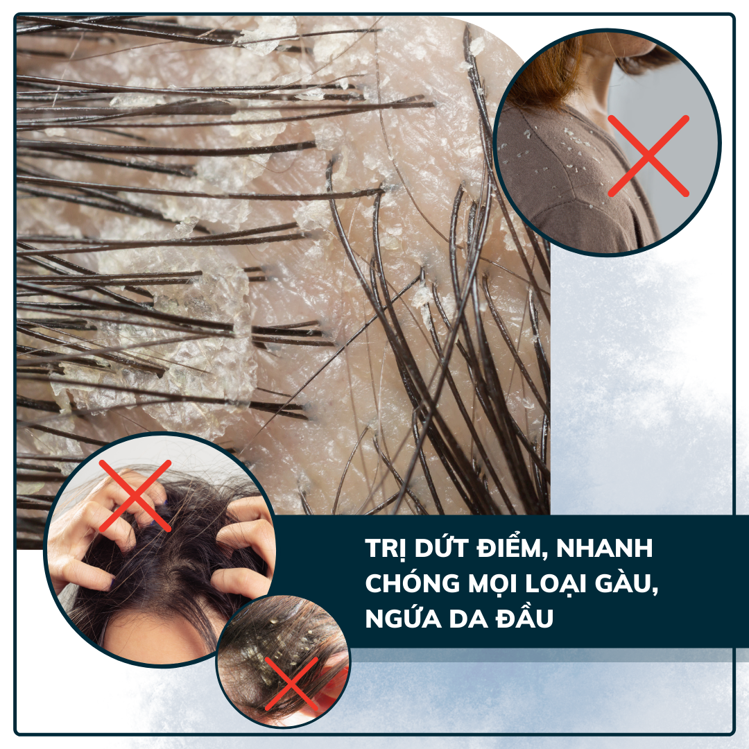 Combo 4 Dầu gội hết nấm da đầu và mảng gàu trắng Dego Pharma - dầu gội tri gàu, dầu gội tri nấm, hết ngứa, cải thiện vảy gàu trắng, á sừng, vảy nến, giảm rụng tóc và kích thích mọc tóc - nguyên liệu nhập khẩu từ Đức