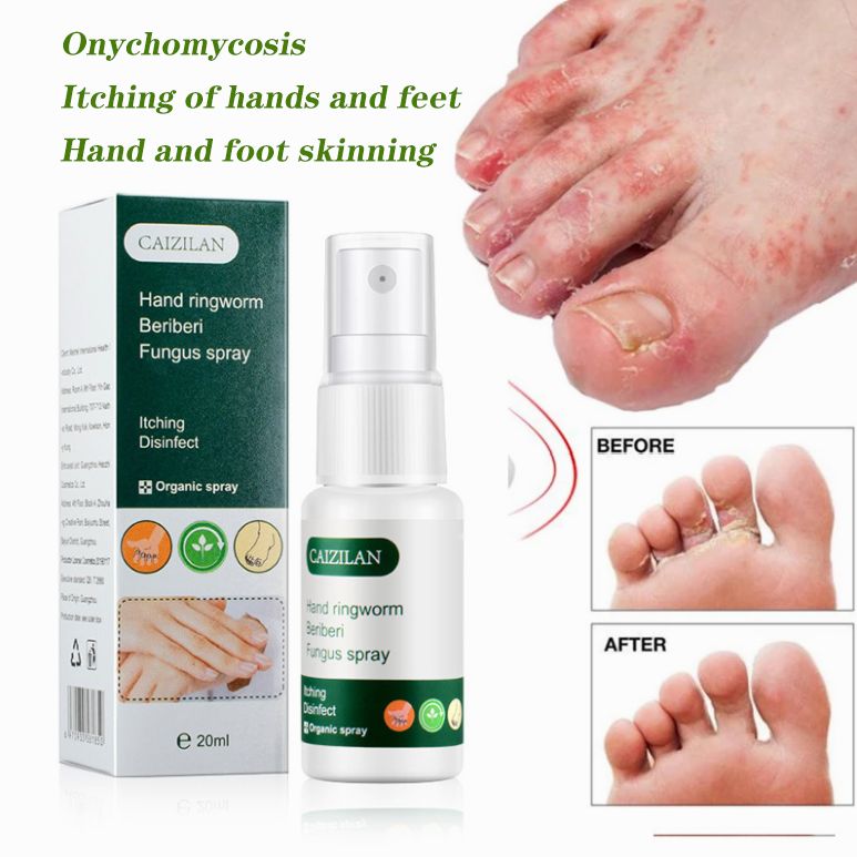 Gambar [Genuine] hand and foot skin peeling antibacterial spray hand and foot spray for dry 20ml, cracked skin and skin conditioning Ointment for beriberi and itchy feet toenail fungus removal athlete s foot, ringworm of the hands