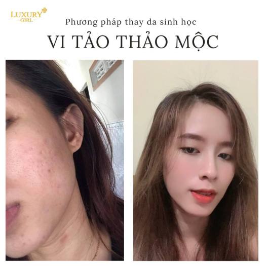 Peel Da Vi Tảo Thảo Mộc Luxury Girl Thay Da Sinh Học