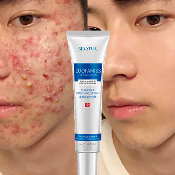 Kem ngăn ngừa mụn, tinh chất làm trắng sáng da, trọng lượng 30g, loại bỏ mụn, xóa sẹo mụn, khắc phục sẹo mụn, dưỡng ẩm sâu