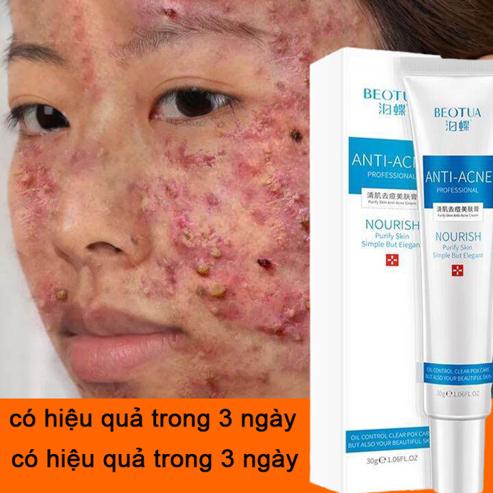 Gel ngừa mụn trọng lượng 30g, Cải thiện mụn tuổi dậy thì, dưỡng ẩm cho da mặt, làm trắng da, giảm mụn đầu đen, mụn cám, mụn cám, , gel ngừa mụn