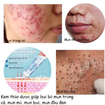 Kem bôi mụn trứng cá, mụn ẩn, mụn bọc, mụn mủ, mụn đầu đen, thành phần thảo dược an toàn 100%