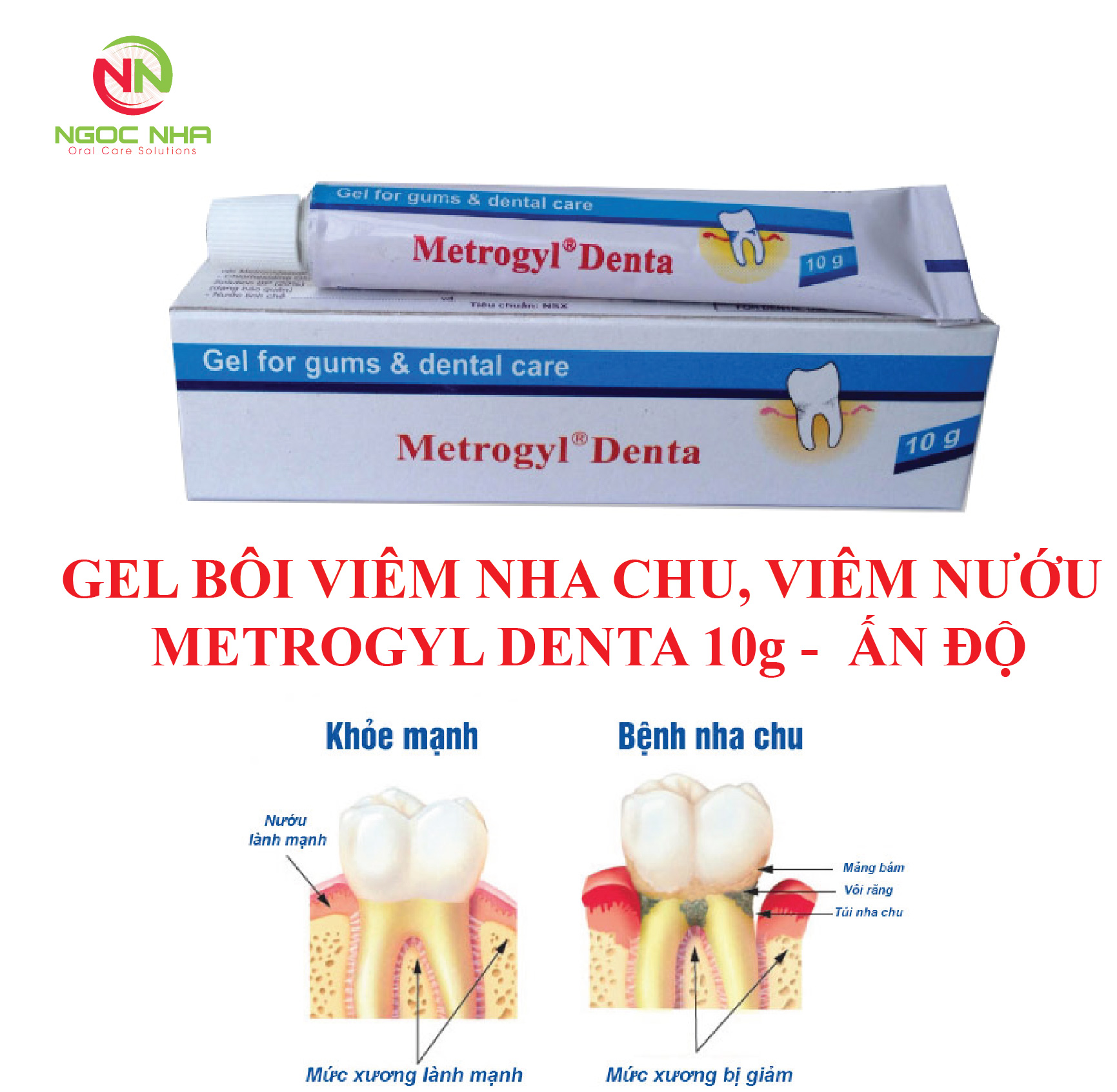 Gel bôi viêm nướu viêm nha chu Metrogyr/ Ấn Độ