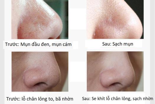 Bột lột mụn Trà Xanh Matcha Nguyên chất - Mặt nạ bột lột mụn giúp hút sạch mụn cám, mụn đầu đen , bã nhờn, thu nhỏ chân lông